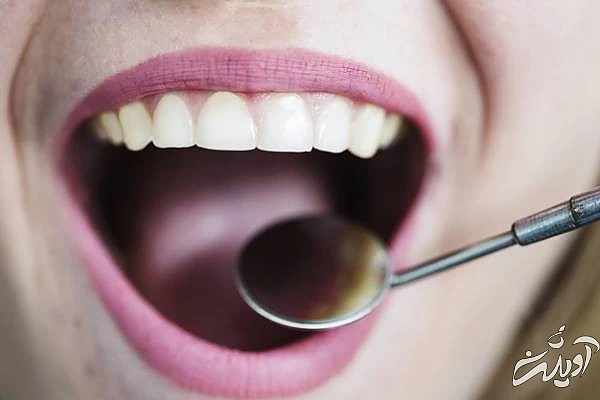 کامپوزیت یا سرامیک